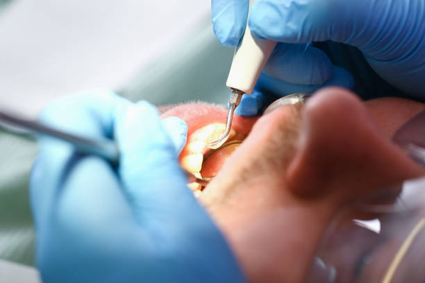 Best Emergency Dental Care for Abscessed Tooth in Key Vista, FL